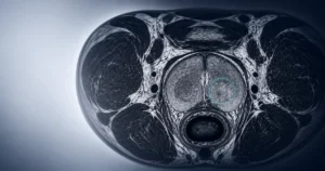 What a PI-RADS 3 Score Means: Biopsy or Not?