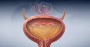 Sleep Apnea and High Blood Pressure: The Nocturia Link