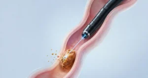 Laser Lithotripsy Recovery: URSL Week-by-Week Guide